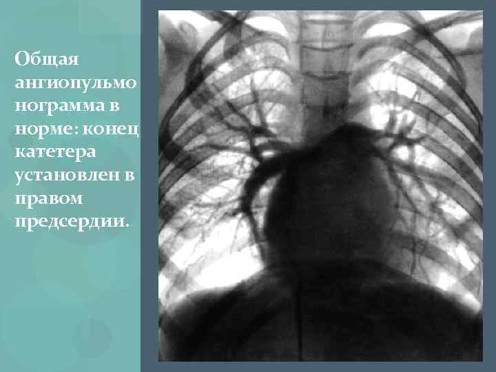 Общая ангиопульмо нограмма в норме: конец катетера установлен в правом предсердии. 