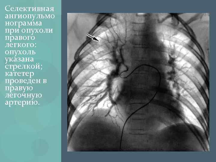 Селективная ангиопульмо нограмма при опухоли правого легкого: опухоль указана стрелкой; катетер проведен в правую