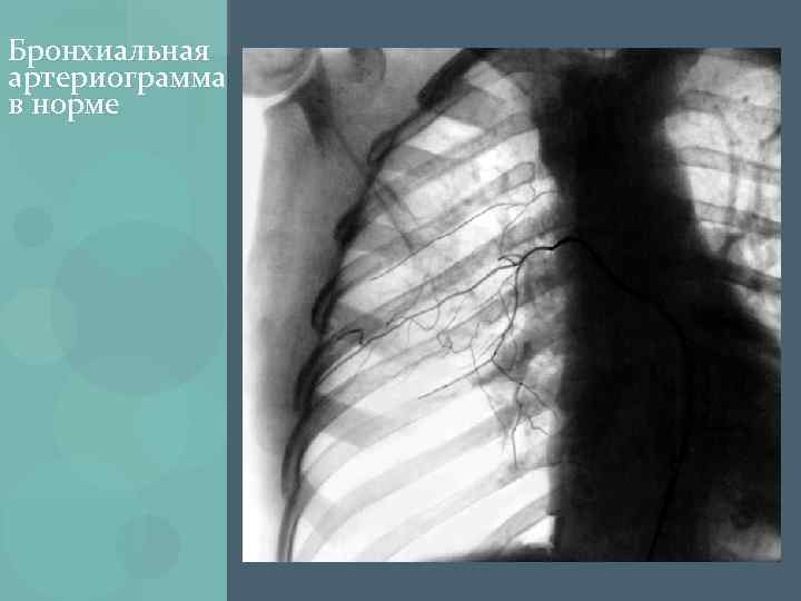 Бронхиальная артериограмма в норме 