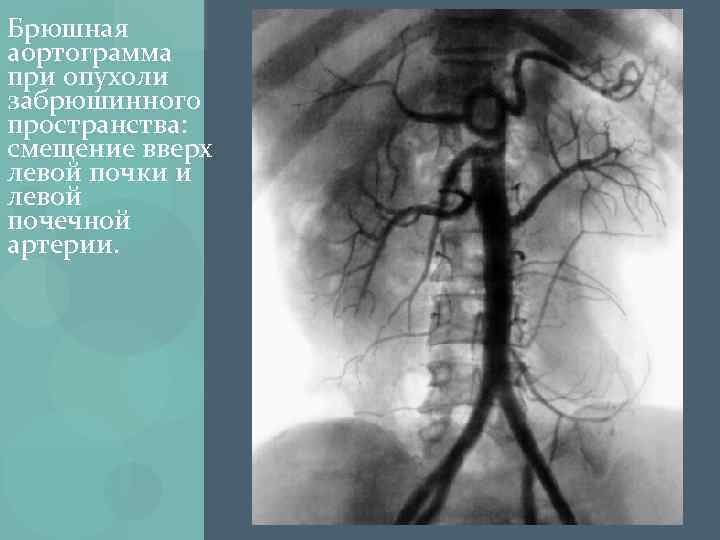 Брюшная аортограмма при опухоли забрюшинного пространства: смещение вверх левой почки и левой почечной артерии.