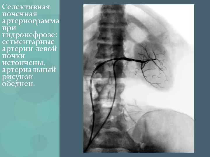 Селективная почечная артериограмма при гидронефрозе: сегментарные артерии левой почки истончены, артериальный рисунок обеднен. 