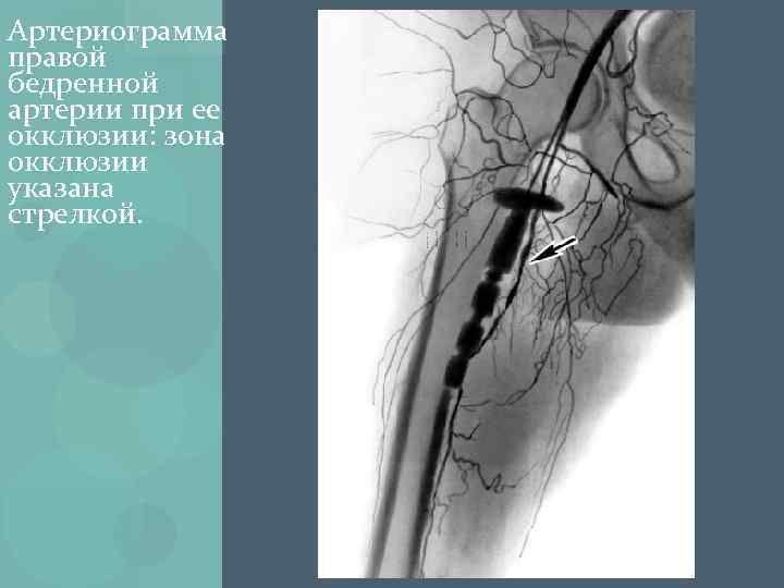 Артериограмма правой бедренной артерии при ее окклюзии: зона окклюзии указана стрелкой. 