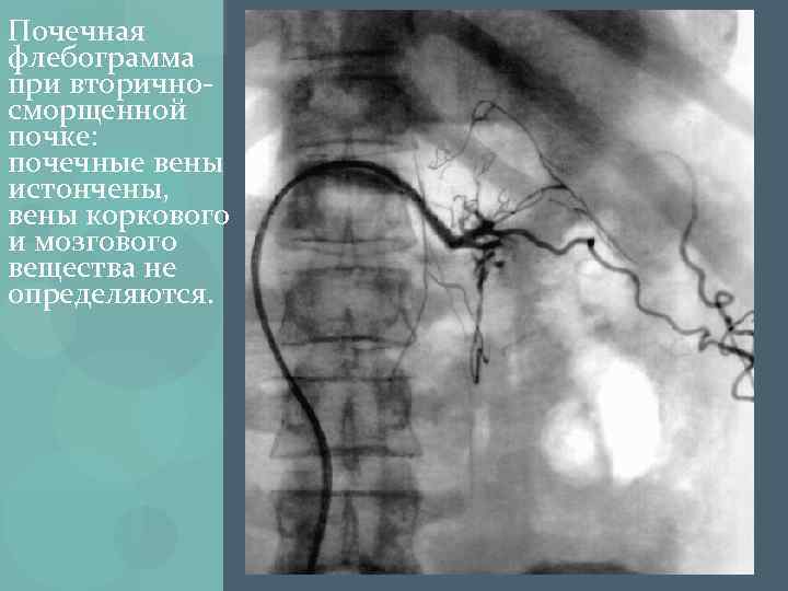 Почечная флебограмма при вторичносморщенной почке: почечные вены истончены, вены коркового и мозгового вещества не