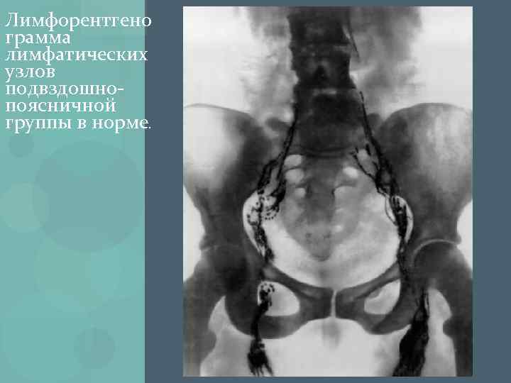 Лимфорентгено грамма лимфатических узлов подвздошнопоясничной группы в норме. 
