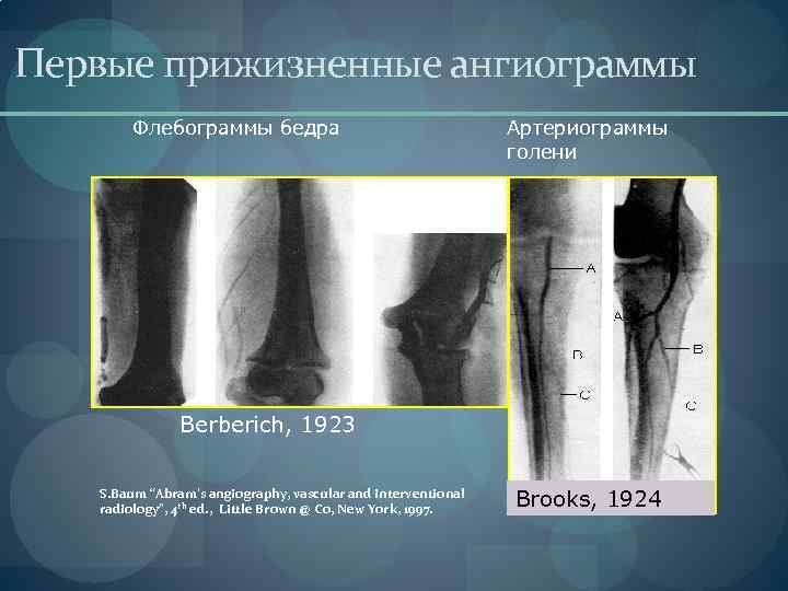 Первые прижизненные ангиограммы Флебограммы бедра Артериограммы голени Berberich, 1923 S. Baum “Abram’s angiography, vascular