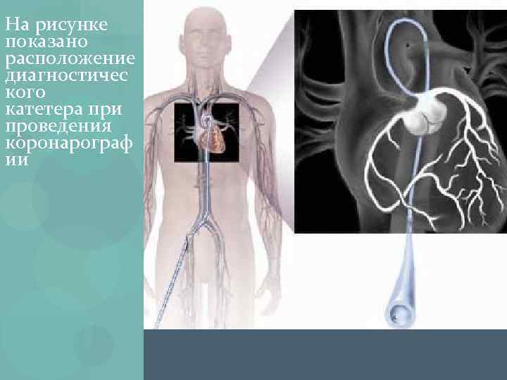 На рисунке показано расположение диагностичес кого катетера при проведения коронарограф ии 
