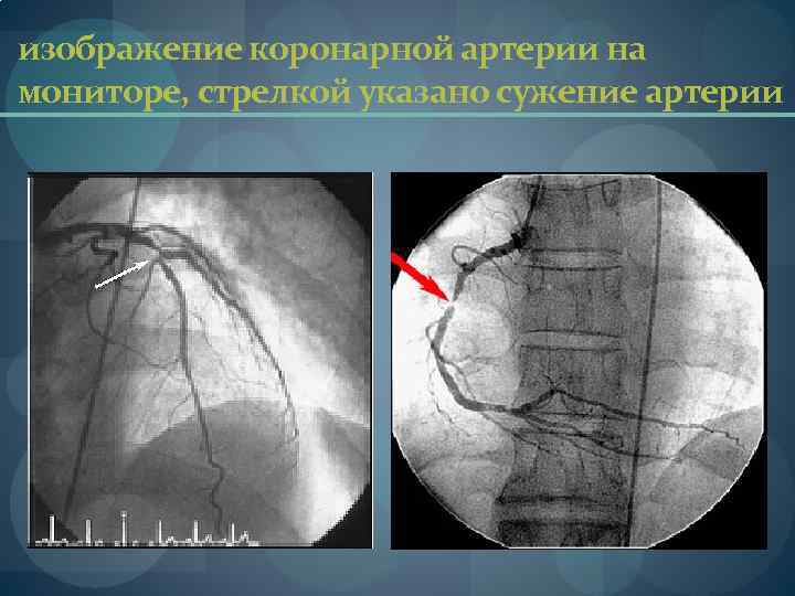 изображение коронарной артерии на мониторе, стрелкой указано сужение артерии 