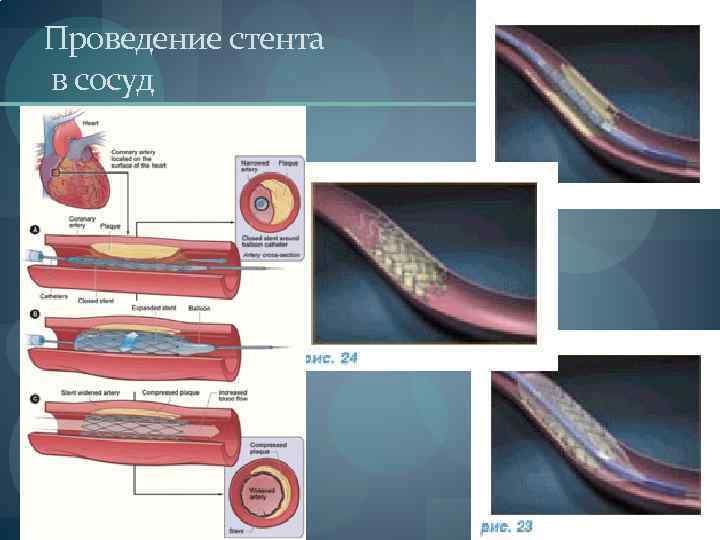 Проведение стента в сосуд 