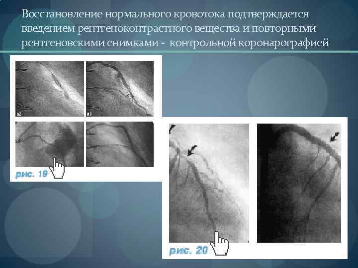 Коронарография фото с описанием патологии