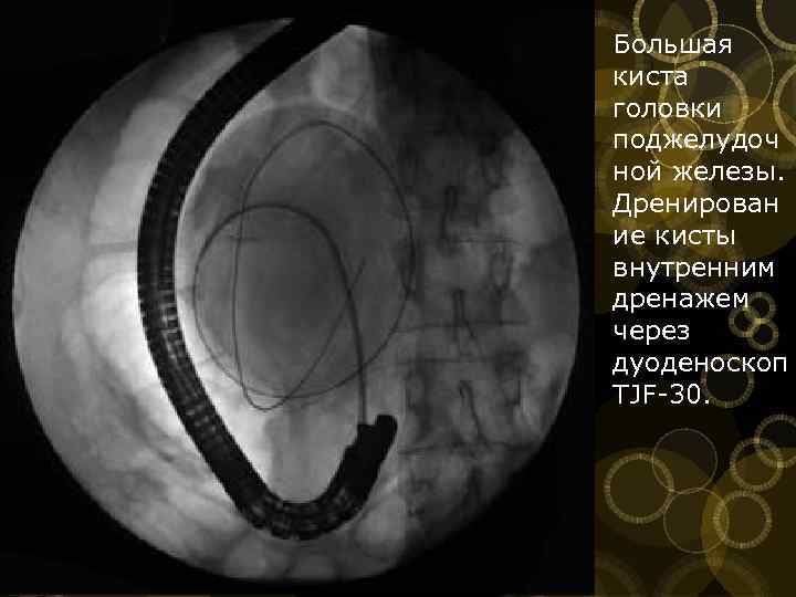 Большая киста головки поджелудоч ной железы. Дренирован ие кисты внутренним дренажем через дуоденоскоп ТJF