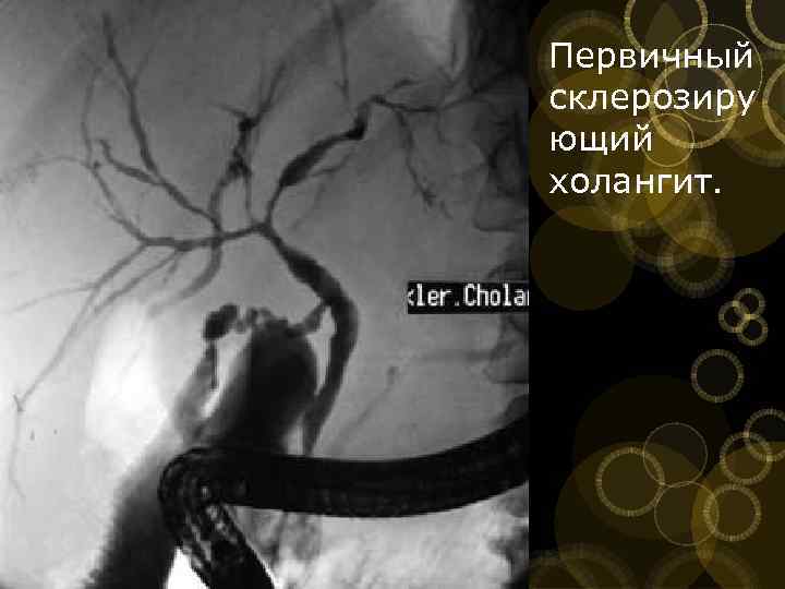 Первичный склерозиру ющий холангит. 