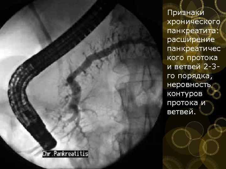 Признаки хронического панкреатита: расширение панкреатичес кого протока и ветвей 2 3 го порядка, неровность