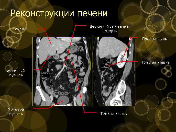 Реконструкции печени Печень Верхняя брыжеечная артерия Правая почка Толстая кишка Желчный пузырь Мочевой пузырь