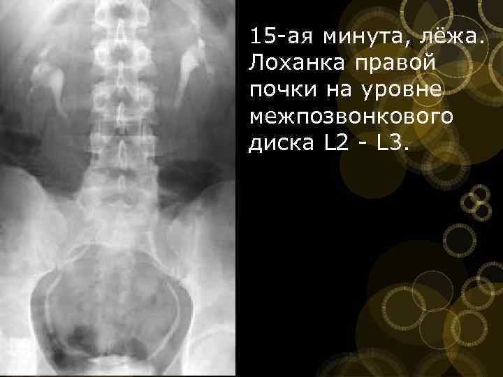 15 ая минута, лёжа. Лоханка правой почки на уровне межпозвонкового диска L 2 L