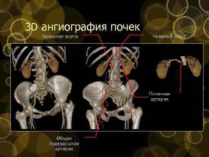 3 D ангиография почек Брюшная аорта Чревный ствол Почечная артерия Общая подвздошная артерия 