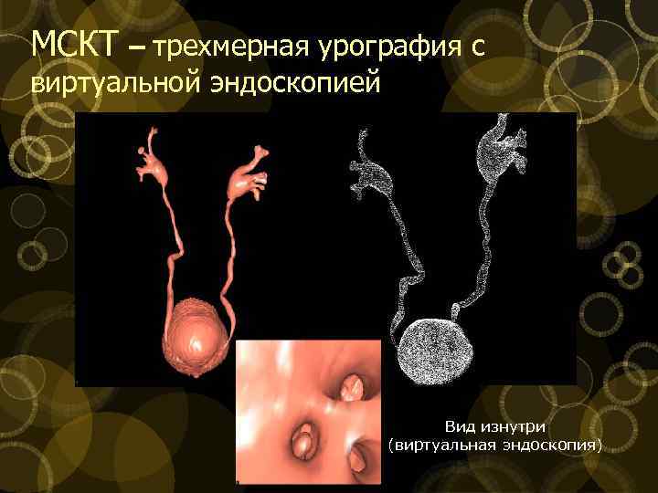 МСКТ – трехмерная урография с виртуальной эндоскопией Вид изнутри (виртуальная эндоскопия) 