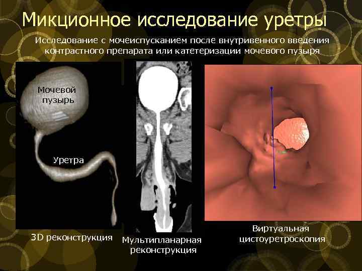 Микционное исследование уретры Исследование с мочеиспусканием после внутривенного введения контрастного препарата или катетеризации мочевого