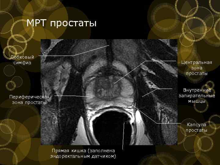 Зоны простаты на узи схема