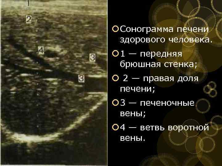  Сонограмма печени здорового человека. 1 — передняя брюшная стенка; 2 — правая доля