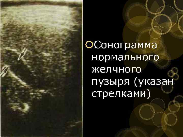  Сонограмма нормального желчного пузыря (указан стрелками) 