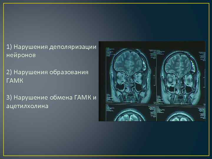 1) Нарушения деполяризации нейронов 2) Нарушения образования ГАМК 3) Нарушение обмена ГАМК и ацетилхолина