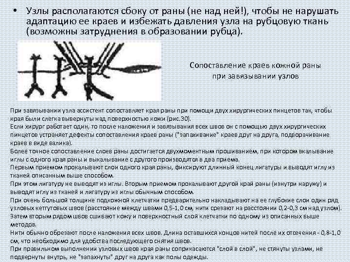  • Узлы располагаются сбоку от раны (не над ней!), чтобы не нарушать адаптацию