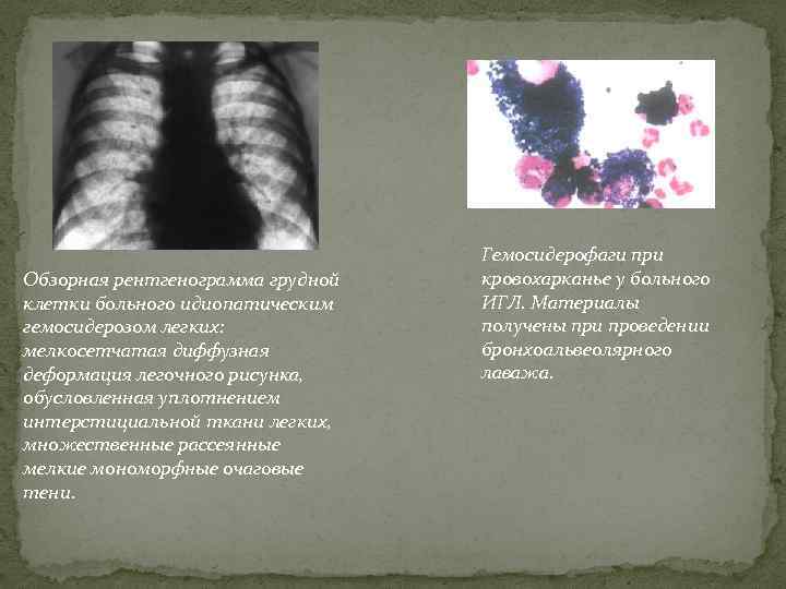 Мелкосетчатая деформация легочного рисунка