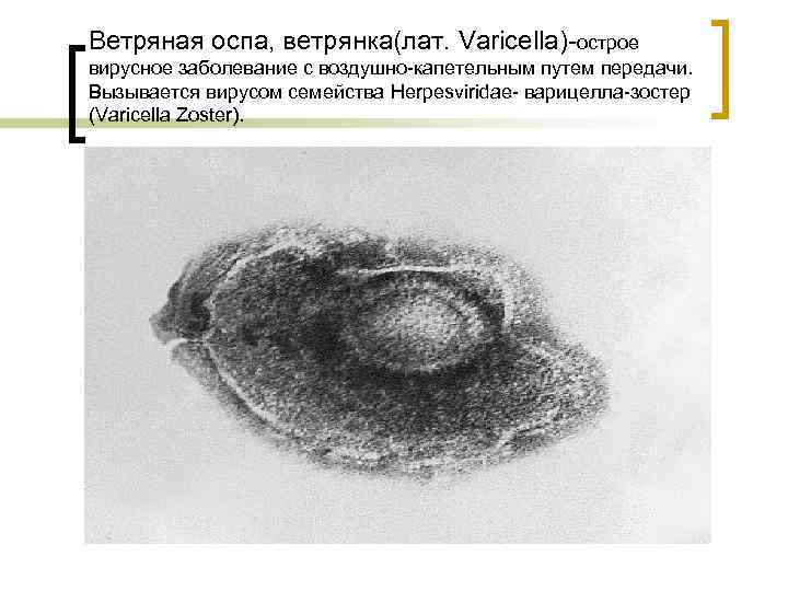 Ветряная оспа, ветрянка(лат. Varicella)-острое вирусное заболевание с воздушно-капетельным путем передачи. Вызывается вирусом семейства Herpesviridae-