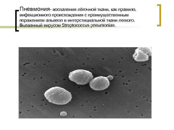 Пневмония- воспаления лёгочной ткани, как правило, инфекционного происхождения с преимущественным поражением альвеол и интерстициальной