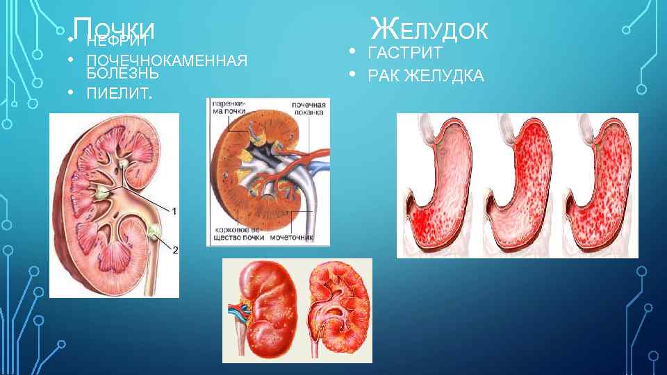  • ПОЧКИ НЕФРИТ • ПОЧЕЧНОКАМЕННАЯ • БОЛЕЗНЬ ПИЕЛИТ. • • ЖЕЛУДОК ГАСТРИТ РАК