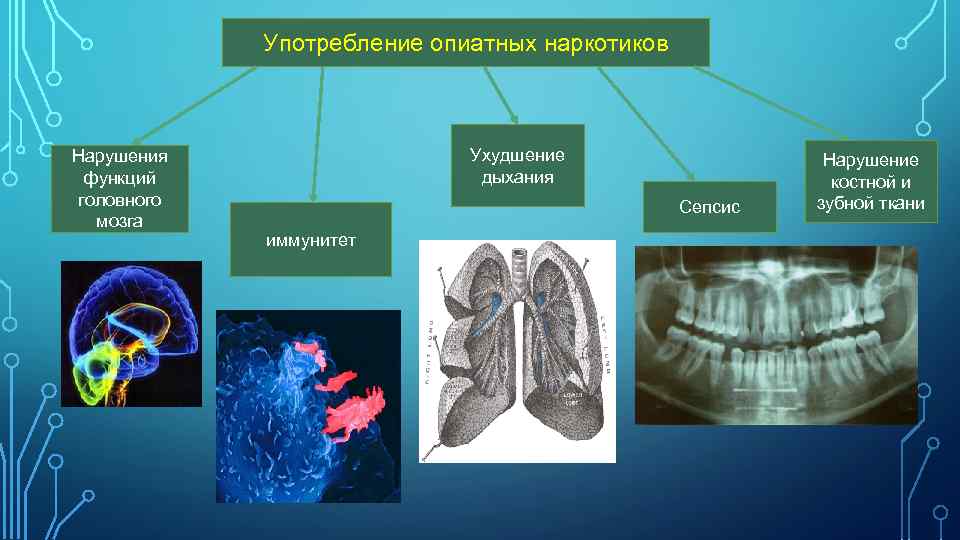 Употребление опиатных наркотиков Нарушения функций головного мозга Ухудшение дыхания Сепсис иммунитет Нарушение костной и