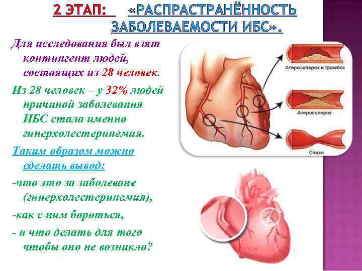 2 ЭТАП: «РАСПРАСТРАНЁННОСТЬ ЗАБОЛЕВАЕМОСТИ ИБС» . Для исследования был взят контингент людей, состоящих из