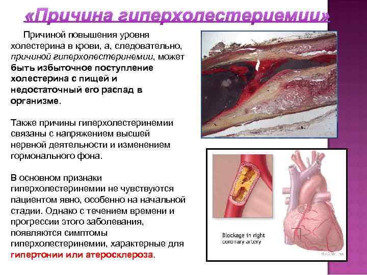  «Причина гиперхолестериемии» Причиной повышения уровня холестерина в крови, а, следовательно, причиной гиперхолестеринемии, может