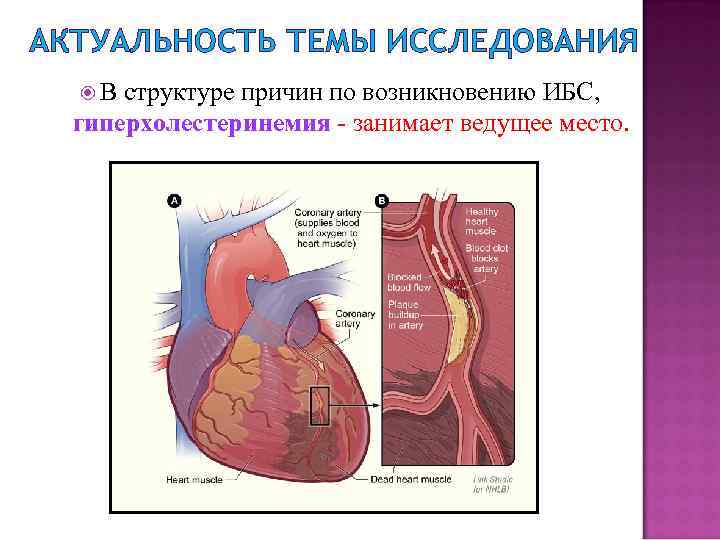 АКТУАЛЬНОСТЬ ТЕМЫ ИССЛЕДОВАНИЯ В структуре причин по возникновению ИБС, гиперхолестеринемия - занимает ведущее место.