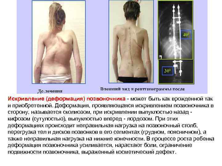 Искривление (деформация) позвоночника может быть как врожденной так и приобретенной. Деформация, проявляющаяся искривлением позвоночника