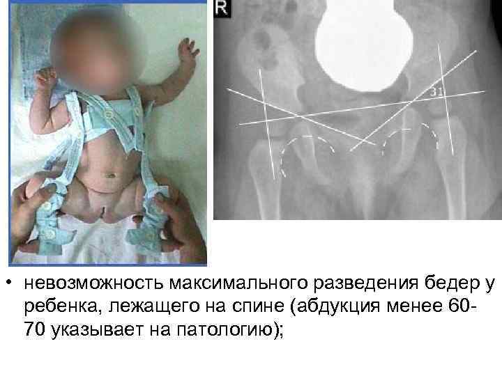  • невозможность максимального разведения бедер у ребенка, лежащего на спине (абдукция менее 60