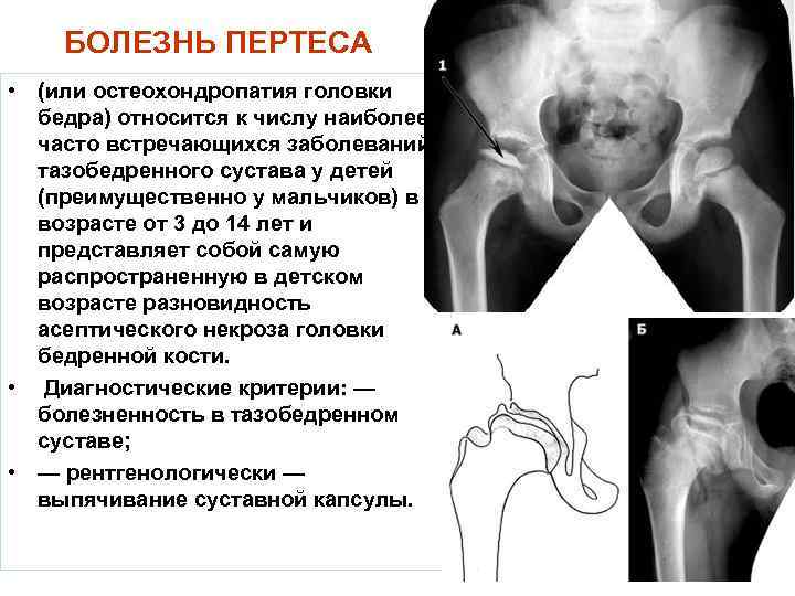 БОЛЕЗНЬ ПЕРТЕСА • (или остеохондропатия головки бедра) относится к числу наиболее часто встречающихся заболеваний