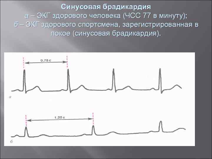 Синусовая брадикардия а – ЭКГ здорового человека (ЧСС 77 в минуту); б – ЭКГ