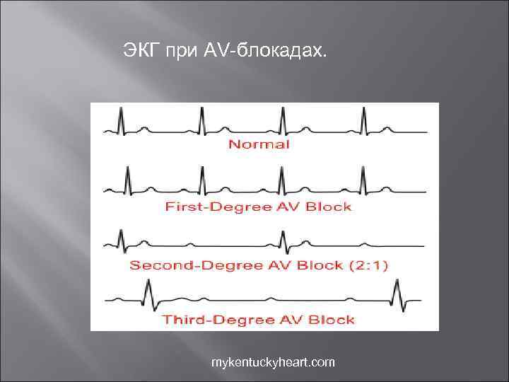 ЭКГ при AV-блокадах. mykentuckyheart. com 