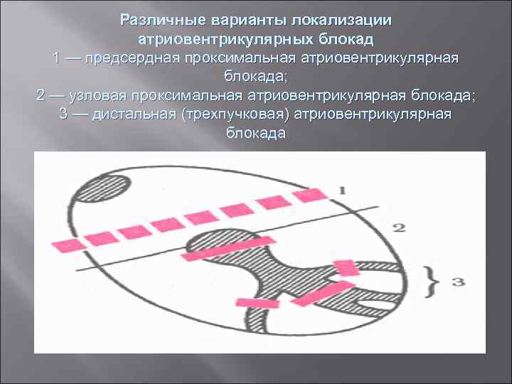 Различные варианты локализации атриовентрикулярных блокад 1 — предсердная проксимальная атриовентрикулярная блокада; 2 — узловая