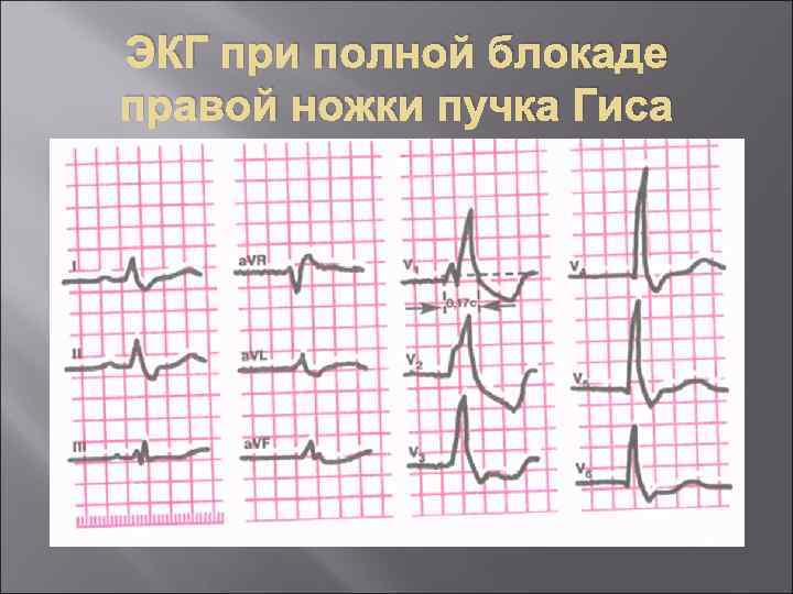 Полная блокада правой ножки гиса. Полная блокада правой ножки. Критерии полной блокады правой ножки. Ритм при полной блокаде правой ножки. Атипичная блокада правой ножки пучка Гиса.