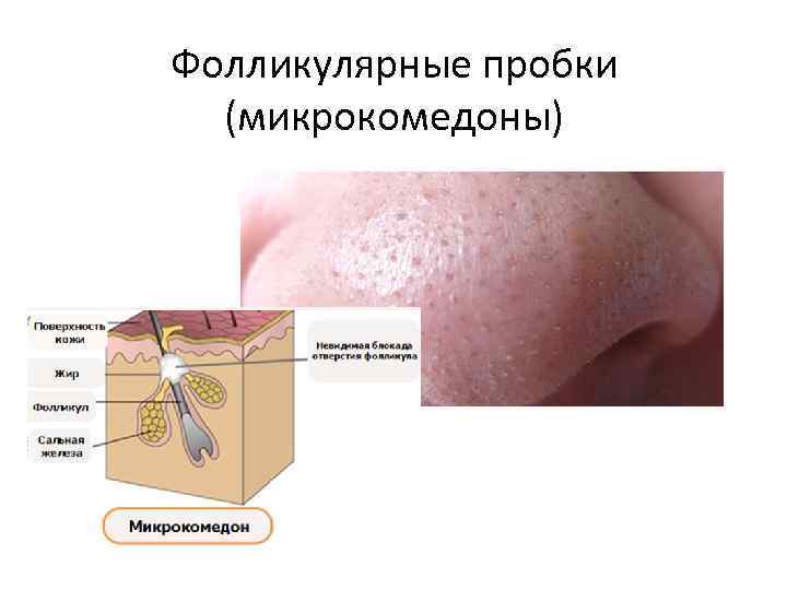 Фолликулярные пробки (микрокомедоны) 