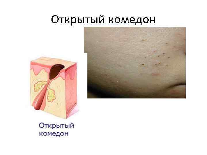 Открытый комедон 