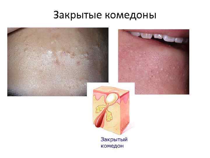 Закрытые комедоны 