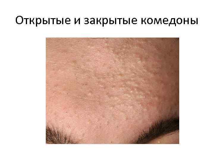 Открытые и закрытые комедоны 