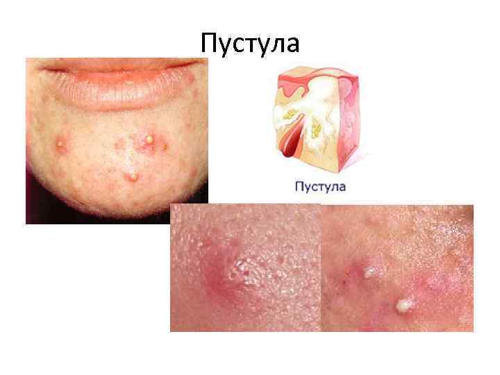 Пустула 