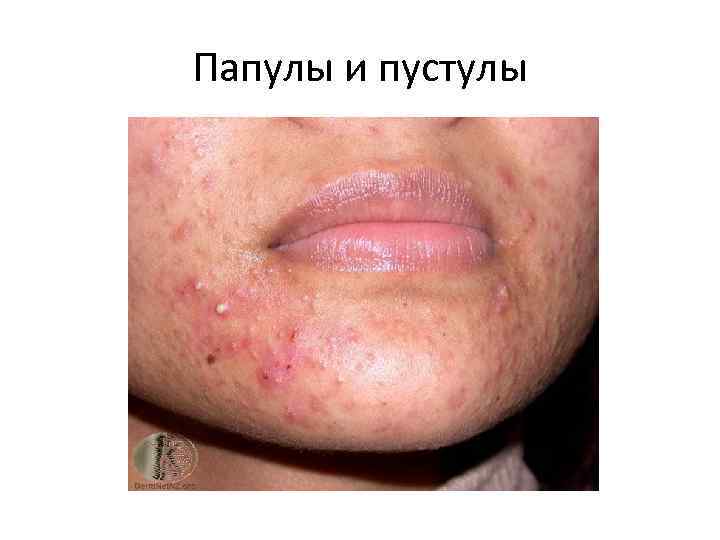 Папулы и пустулы 