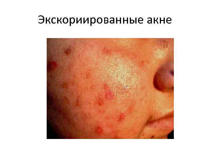 Экскориированные акне 
