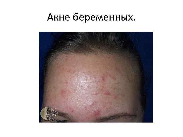 Акне беременных. 