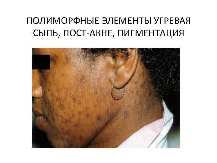 ПОЛИМОРФНЫЕ ЭЛЕМЕНТЫ УГРЕВАЯ СЫПЬ, ПОСТ-АКНЕ, ПИГМЕНТАЦИЯ 